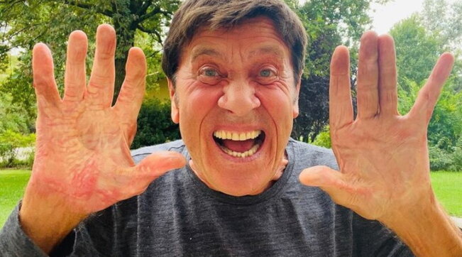 Gianni Morandi mostra la mano ustionata senza benda: “Voglia di urlare”