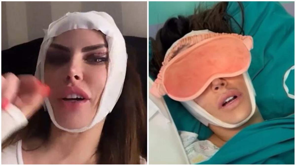 Guendalina Tavassi dopo l’intervento di chirurgia estetica: ecco cosa ha rifatto Guendalina Tavassi dopo l’intervento di chirurgia estetica: ecco cosa ha rifatto